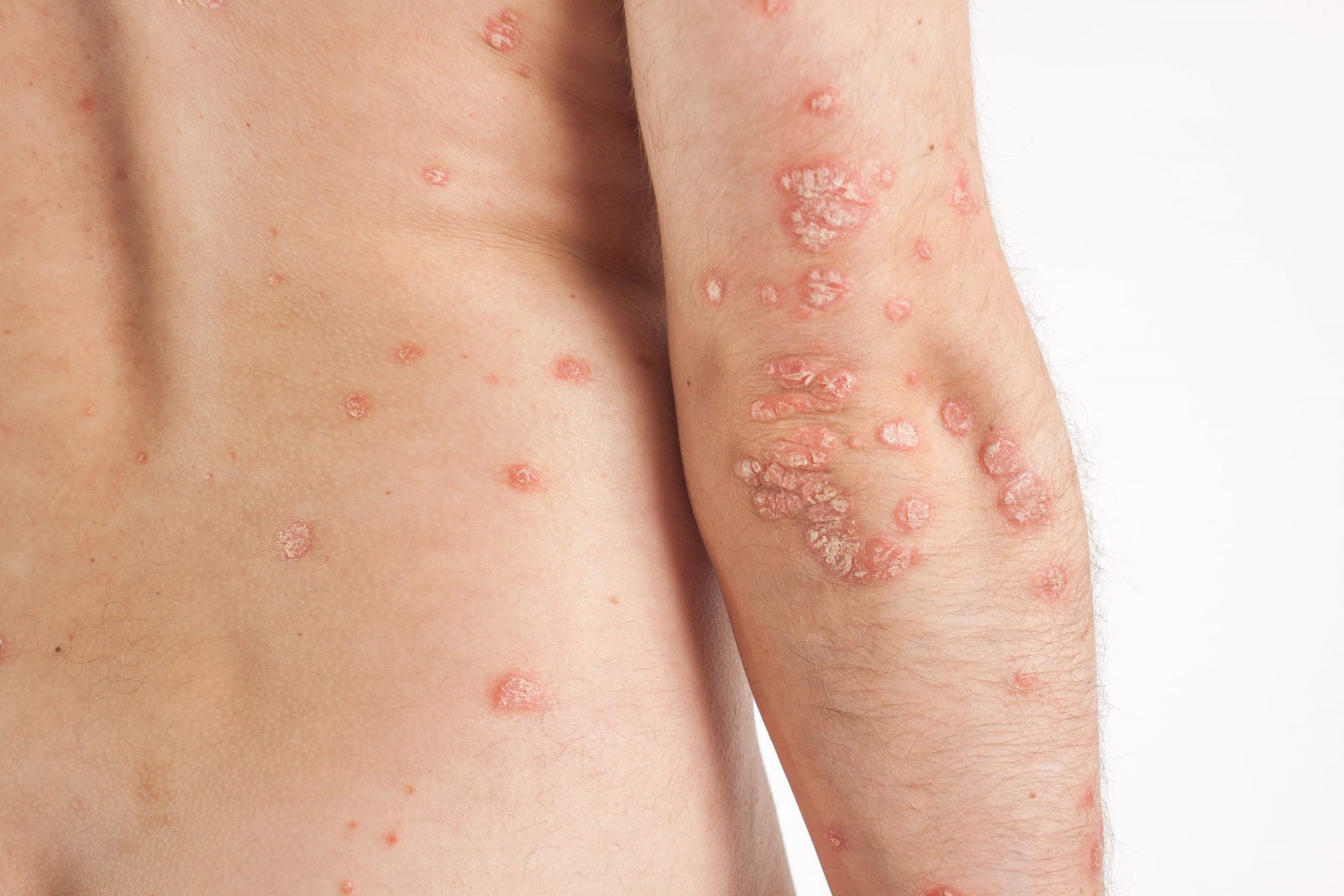 Identifying 21 Common Red Spots on Skin - Universal Dermatology