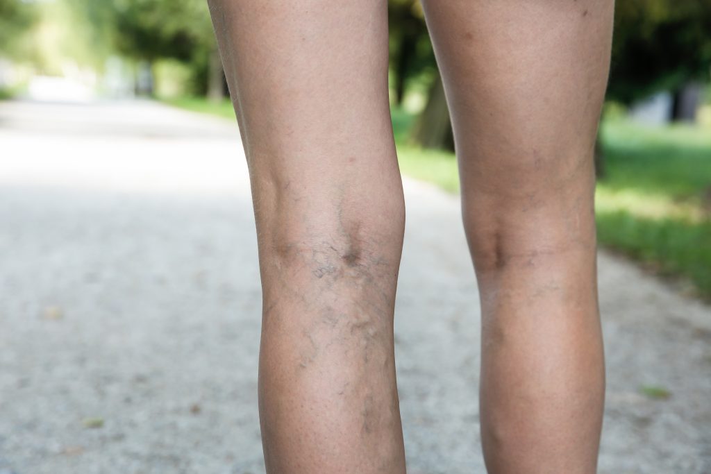 SPIDER VEINS