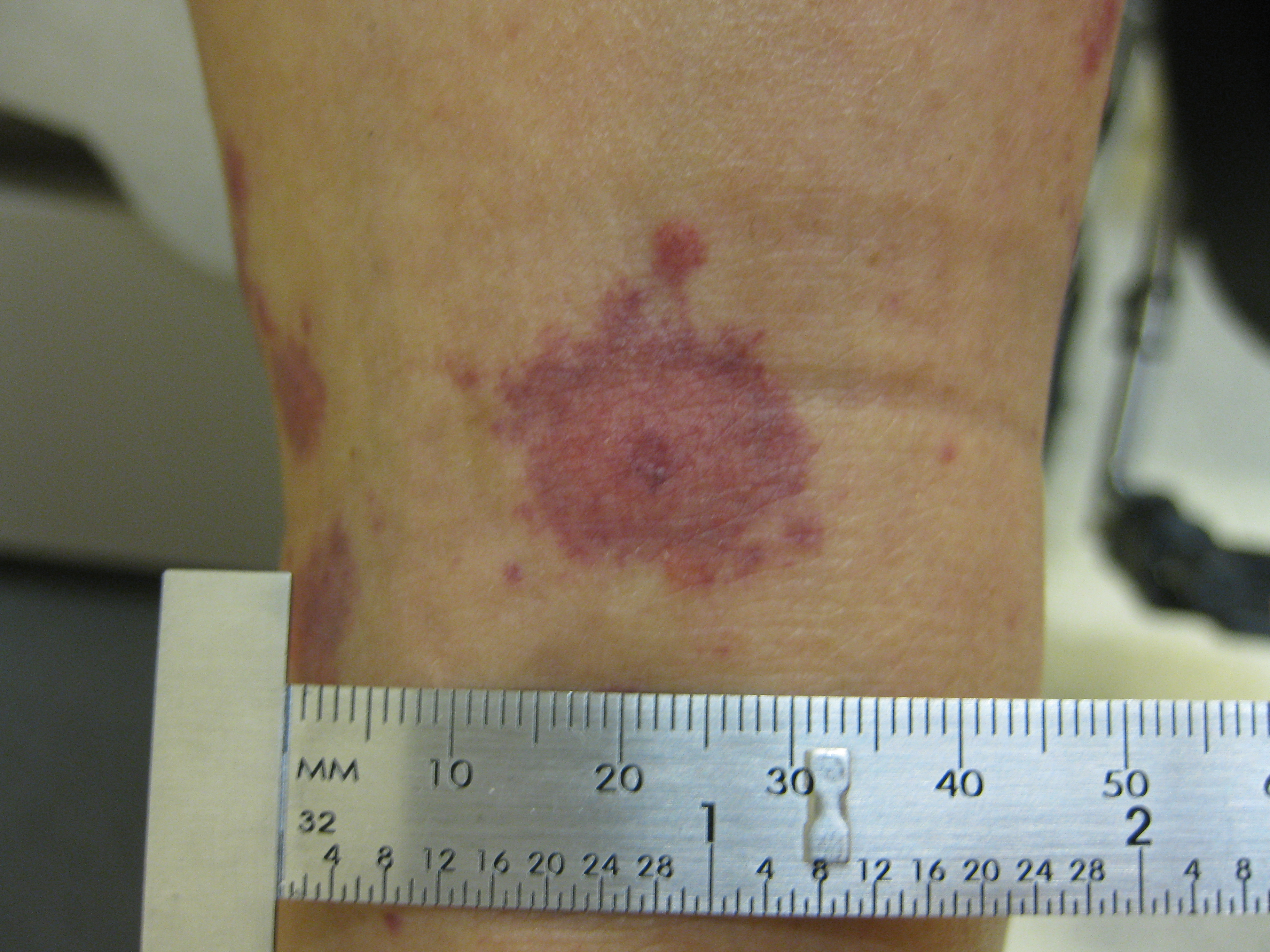 identifying-21-common-red-spots-on-skin - Universal ...