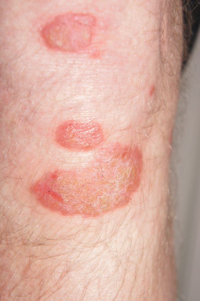 identifying-21-common-red-spots-on-skin-universal-dermatology