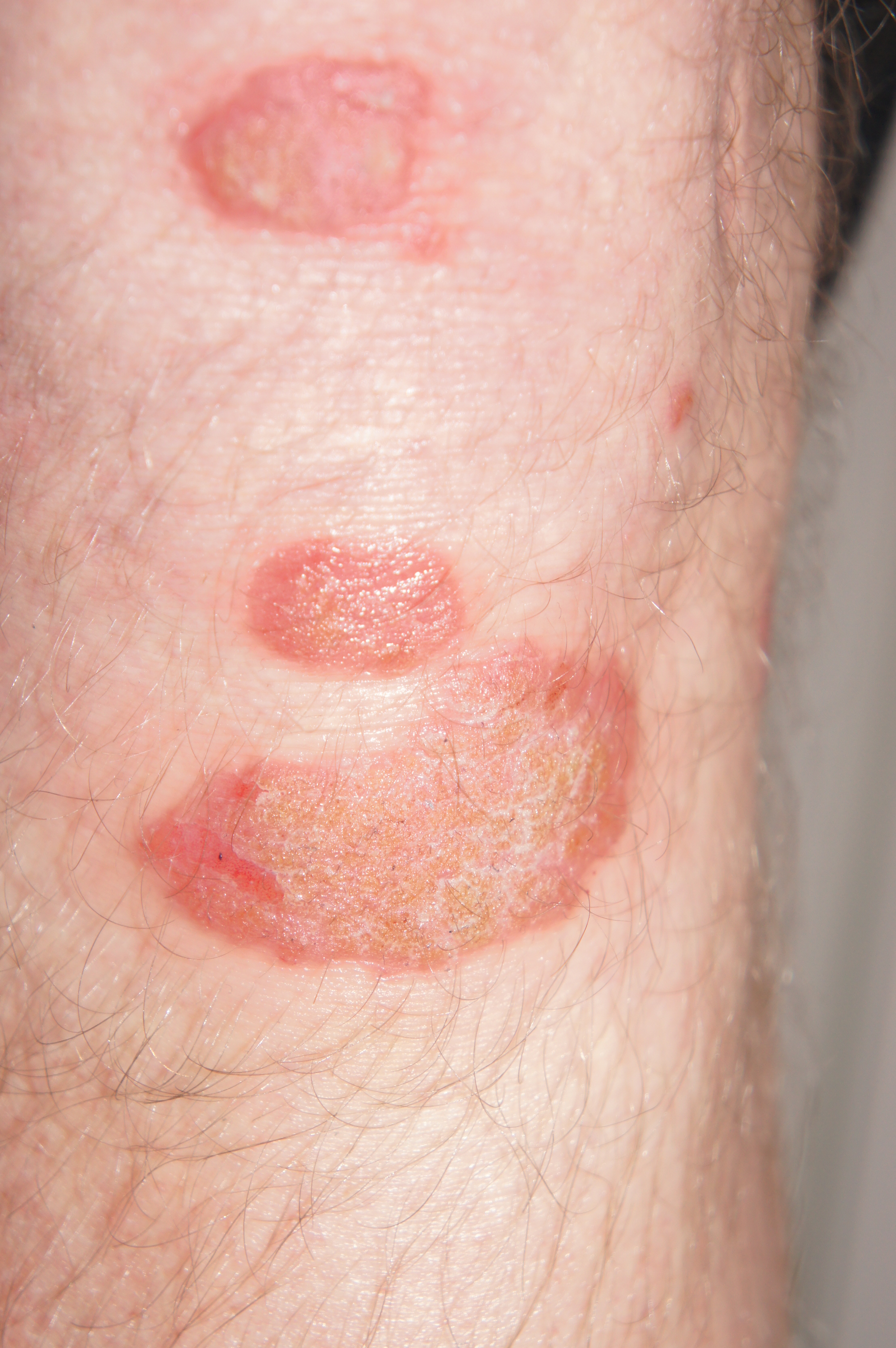 dry-spots-on-leg