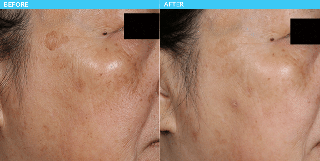 Treatment for Discolored Skin at Universal Dermatology