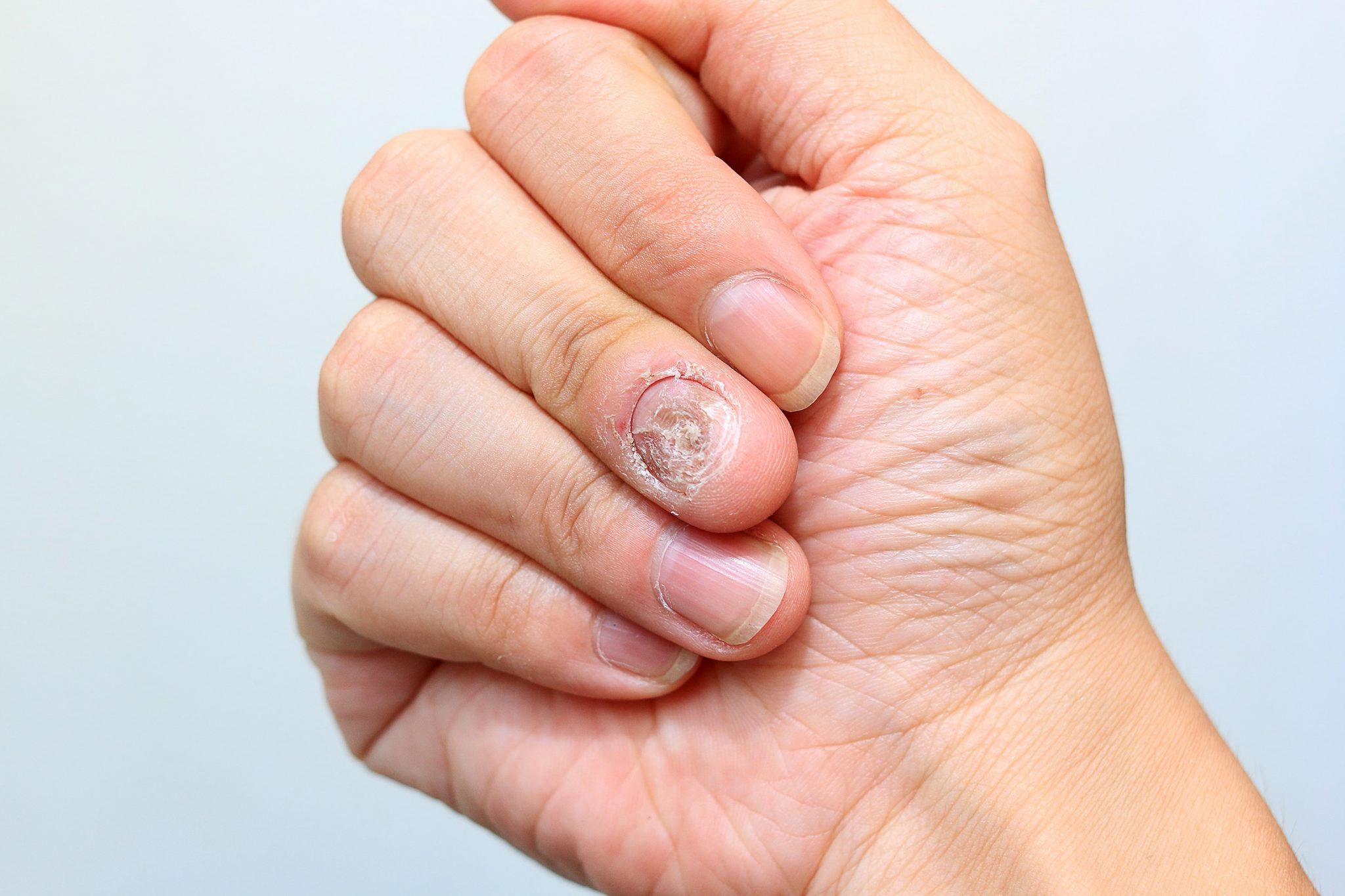 What To Do If Your Finger Nail Comes Off