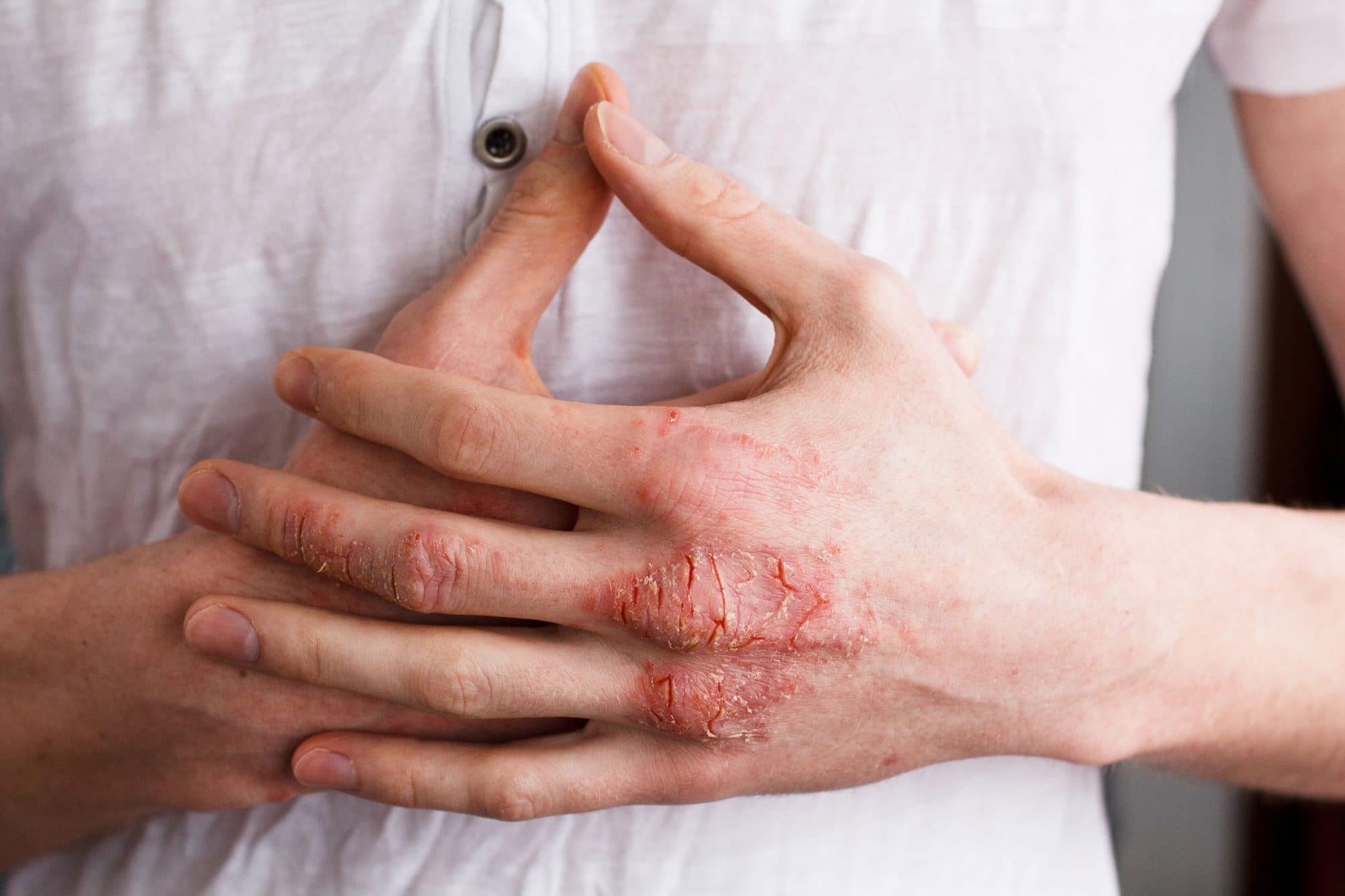 Rough Skin Dry Skin Dry Hands