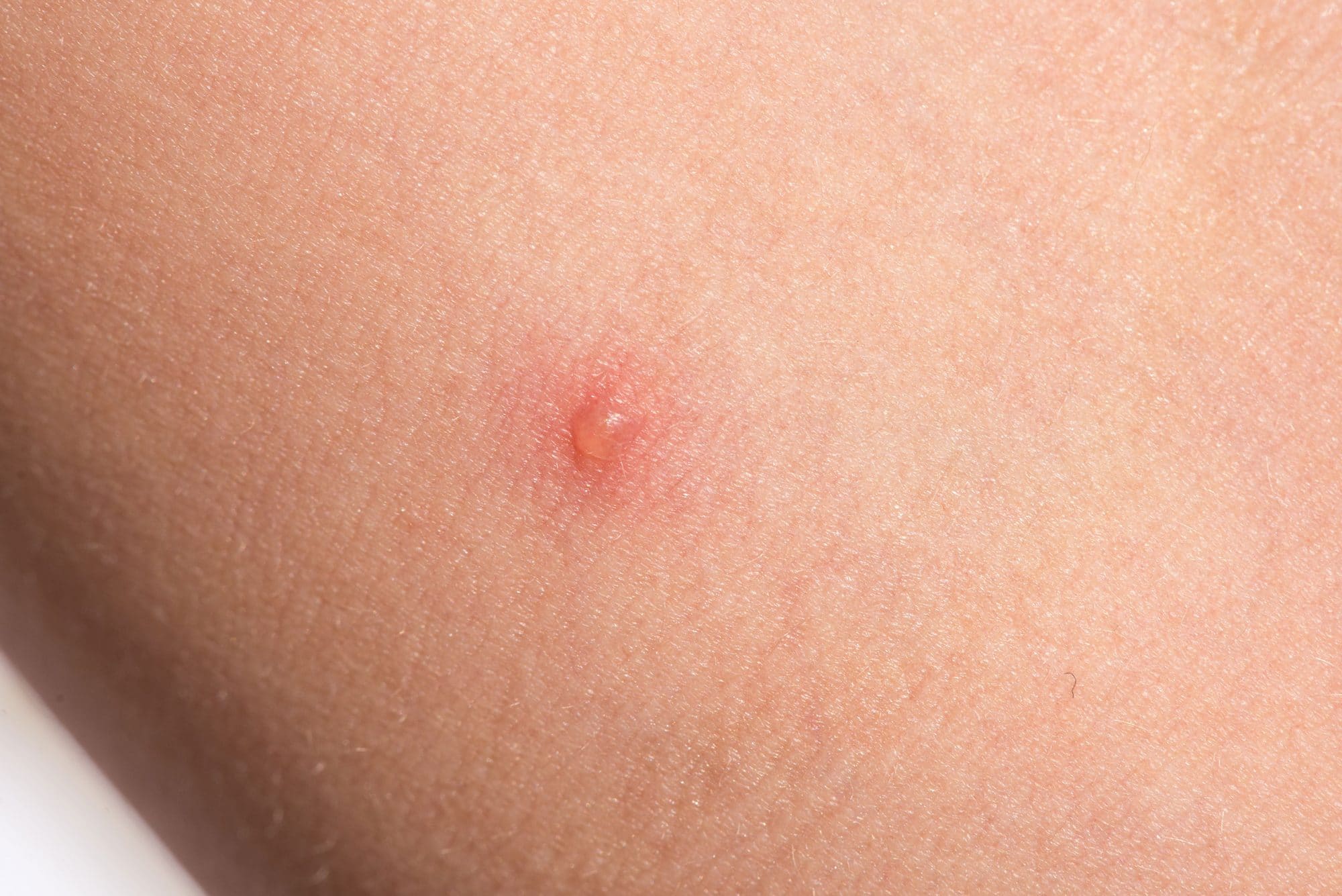bug bites that itch and blister