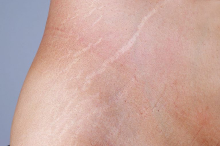 Stretch Marks | Microneedling