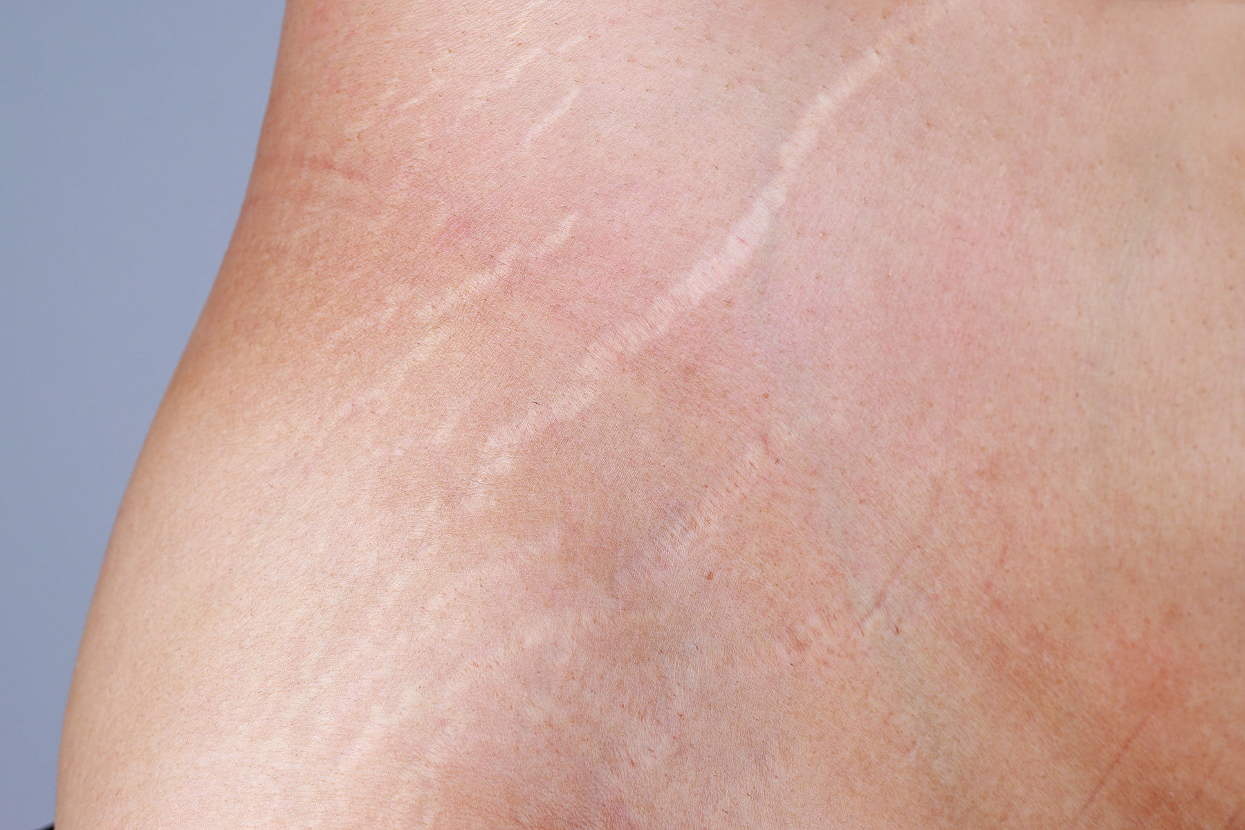 Stretch Marks | Microneedling