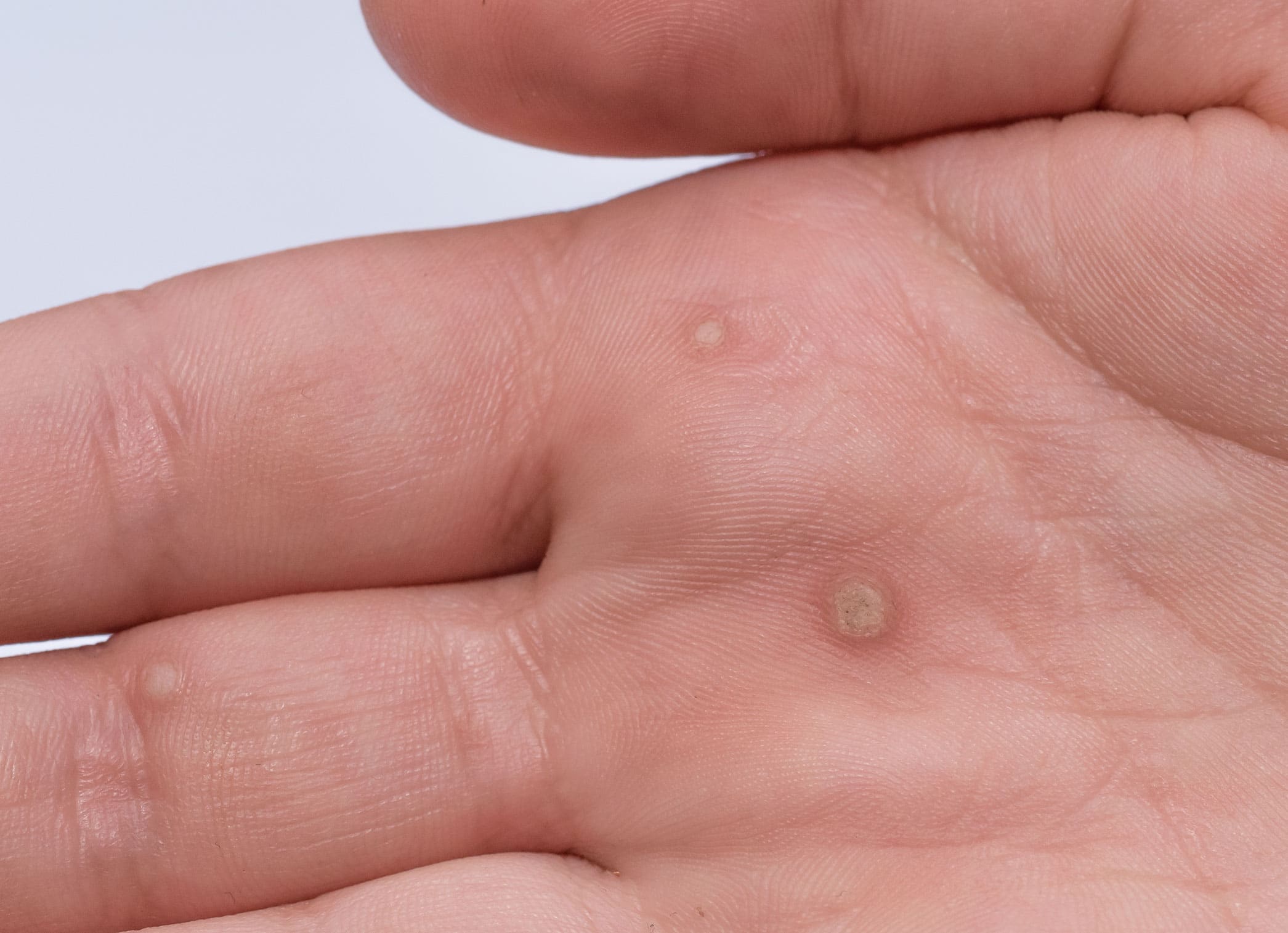 Warts Fungal Skin Infections Viral Skin Infections 