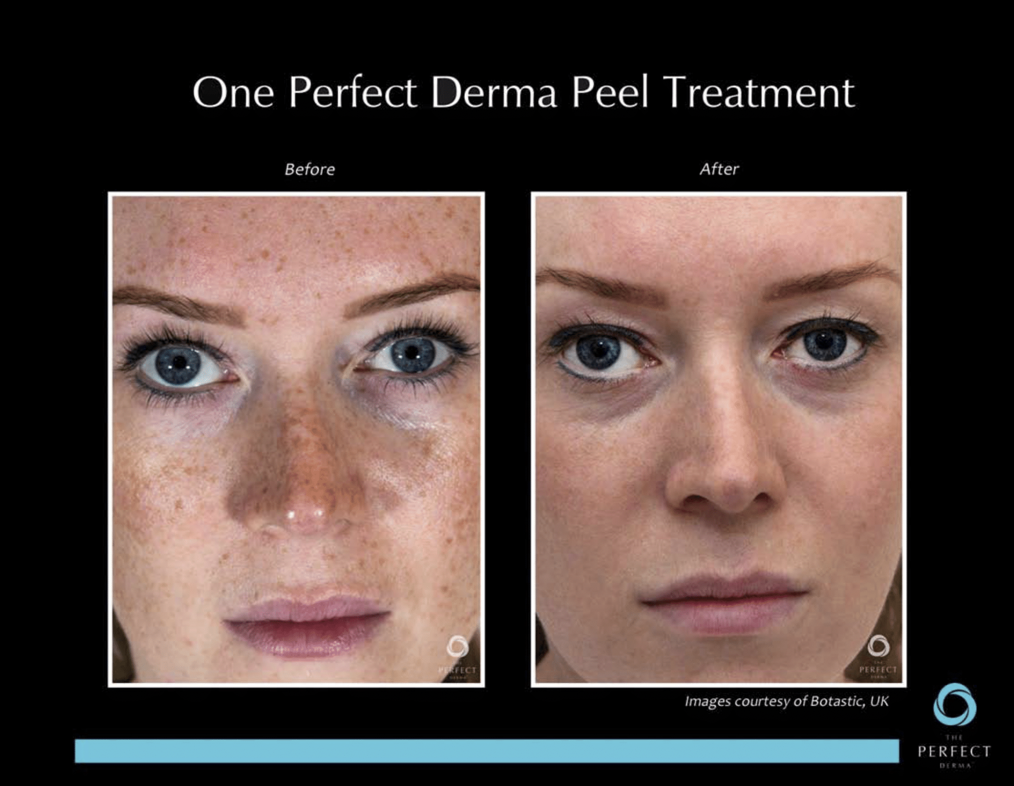 Before & After derma peel