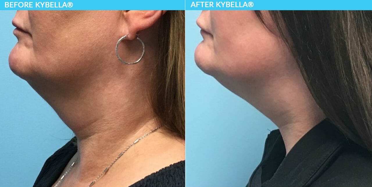 Kybella BA