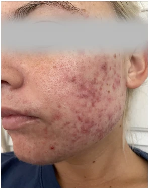 acne treatment