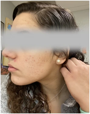 acne treatment