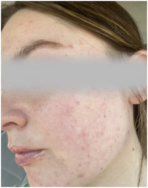 acne treatment