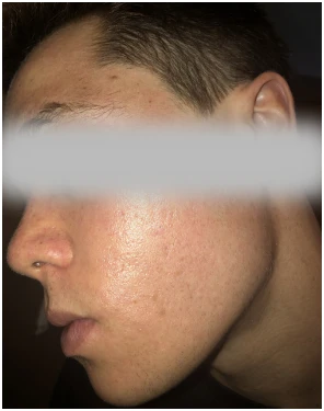 acne treatment