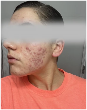 acne treatment