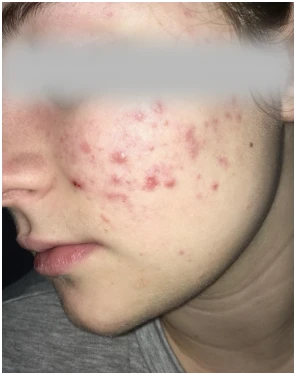 acne before after