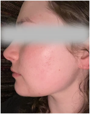 acne before after